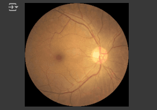 Ocular Disease Image Classifier